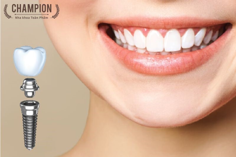 Tại sao nên lựa chọn trồng răng vĩnh viễn Implant Jdentalcare (Ý)