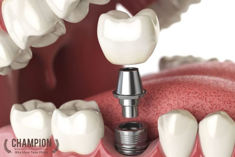 Trồng răng Implant Jdentalcare (Ý) là gì?