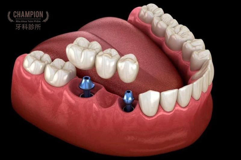 Khắc phục mất răng: Cấy ghép Implant hay hàm giả tháo lắp?