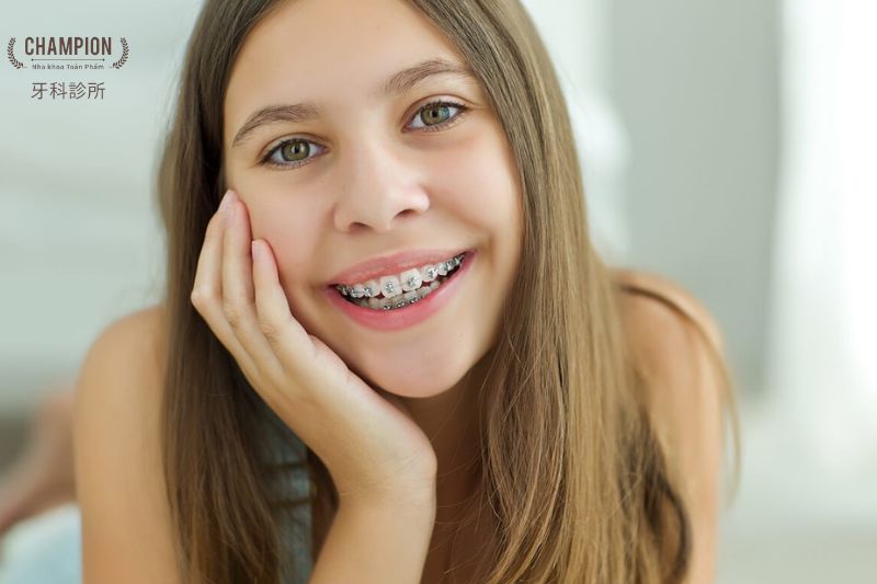 Khi nào nên niềng răng? Độ tuổi nào lý tưởng để niềng răng?
