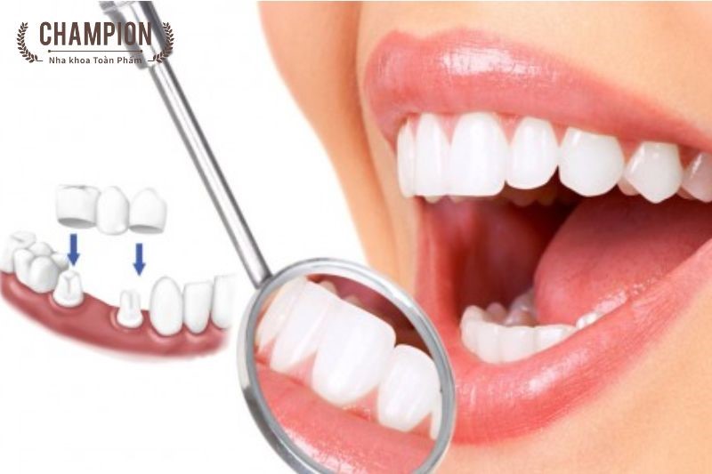 Có nên trồng răng Implant? Kinh nghiệm trồng răng Implant