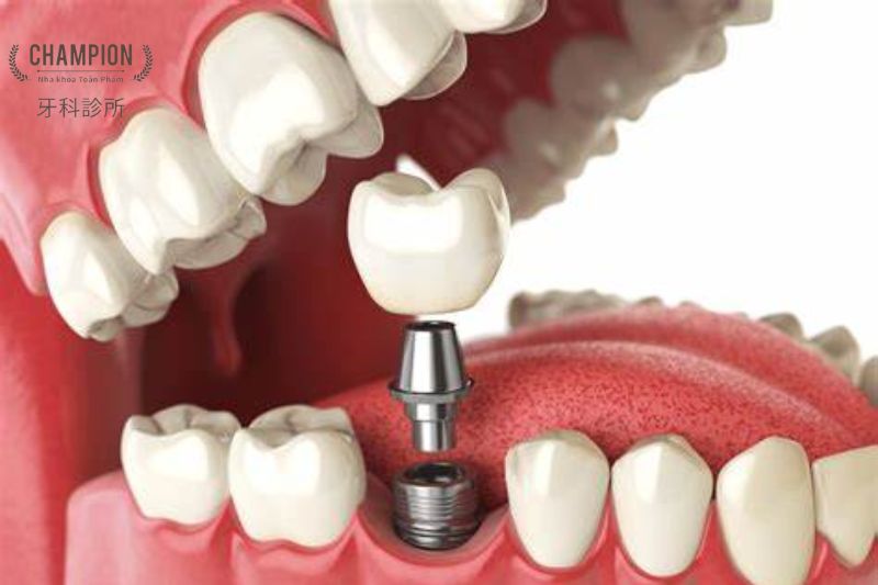 Kỹ thuật nha khoa tiên tiến trong điều trị nứt răng hiện nay