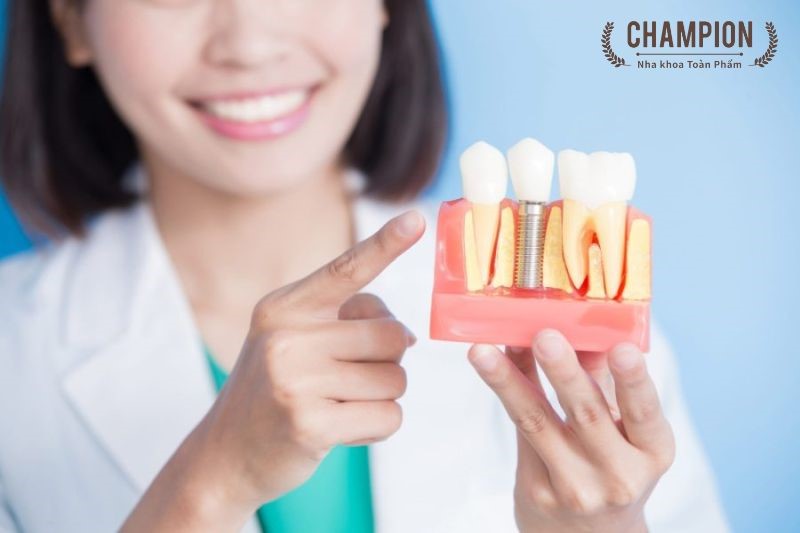 Làm răng Implant có đau không và cách giảm đau nhanh tại nhà