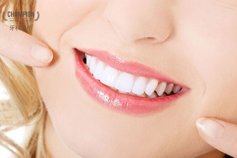 Làm trắng răng tại nhà: Có hiệu quả không và cách thực hiện an toàn