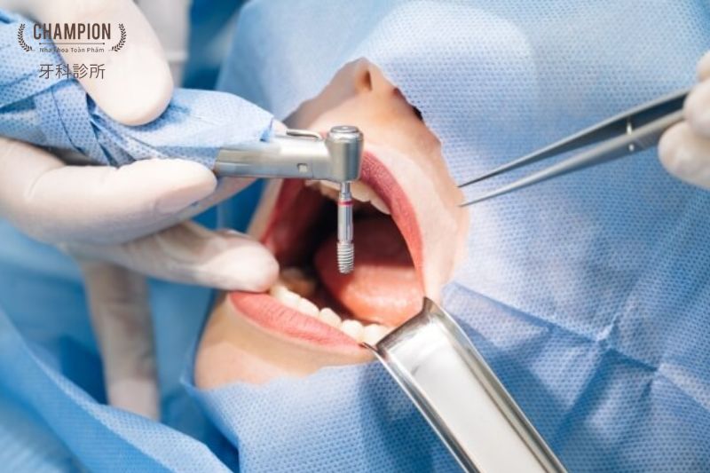 Sau khi cấy ghép implant nên ăn gì?