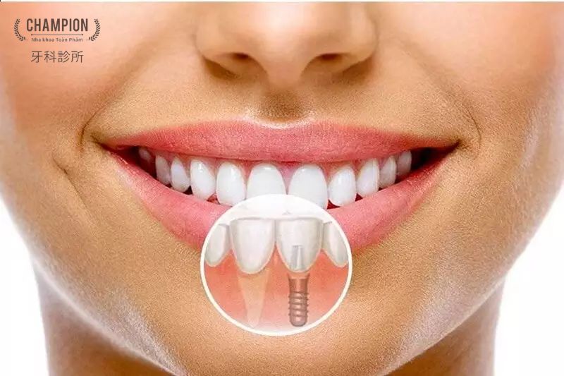 Một số lưu ý sau khi cấy ghép Implant