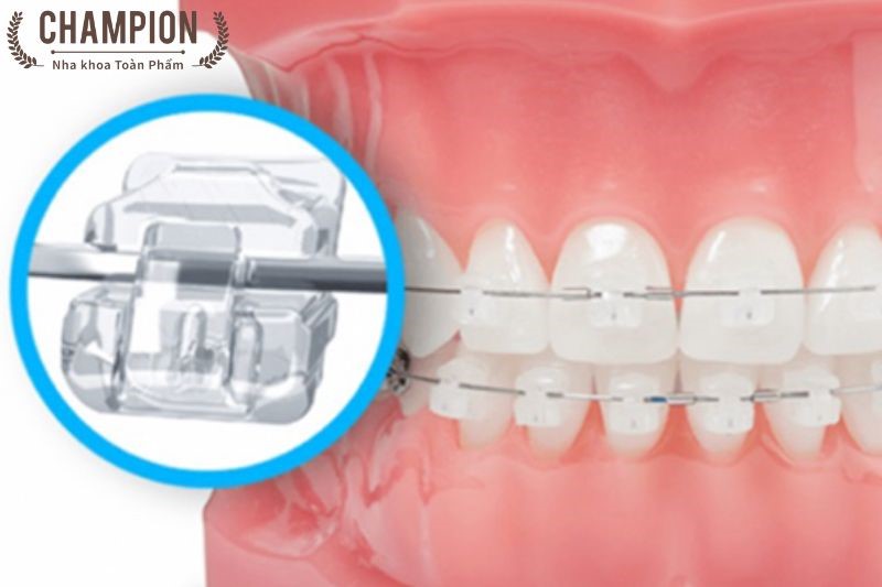 What is orthodontic treatment? - Nha Khoa Numberone