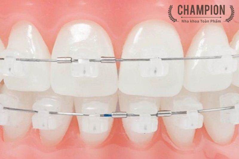 Quy trình niềng răng mắc cài pha lê cổ điển tại Nha khoa Champion