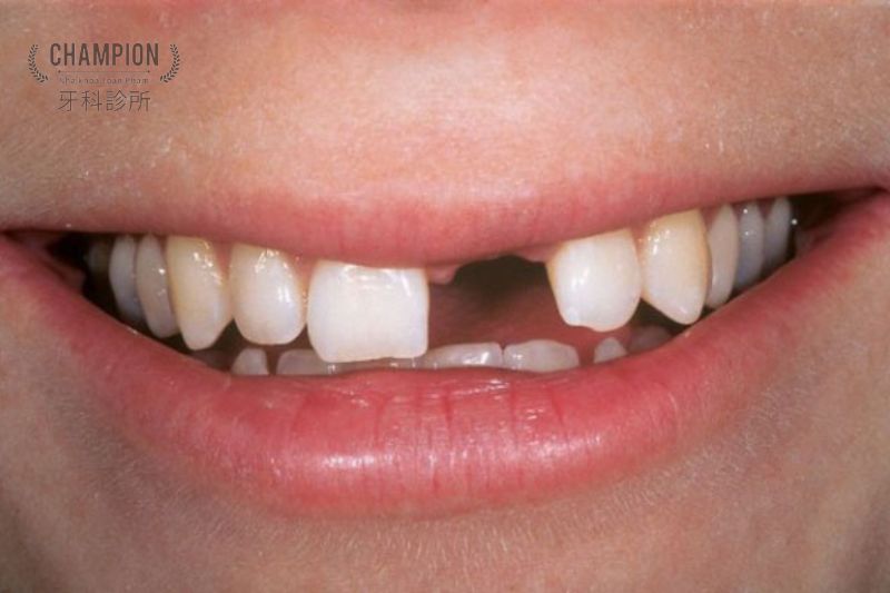 Mất răng: Nguyên nhân, ảnh hưởng và giải pháp khắc phục