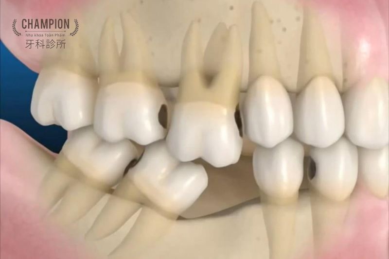 Mất răng lâu năm gây xô lệch răng: Phương pháp phục hình an toàn