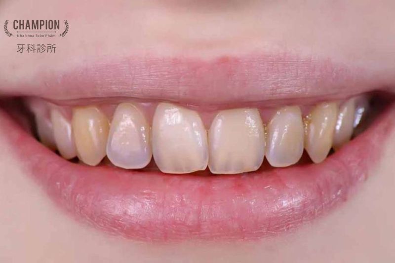 Ảnh hưởng của mòn men răng đến nụ cười và khả năng ăn nhai 