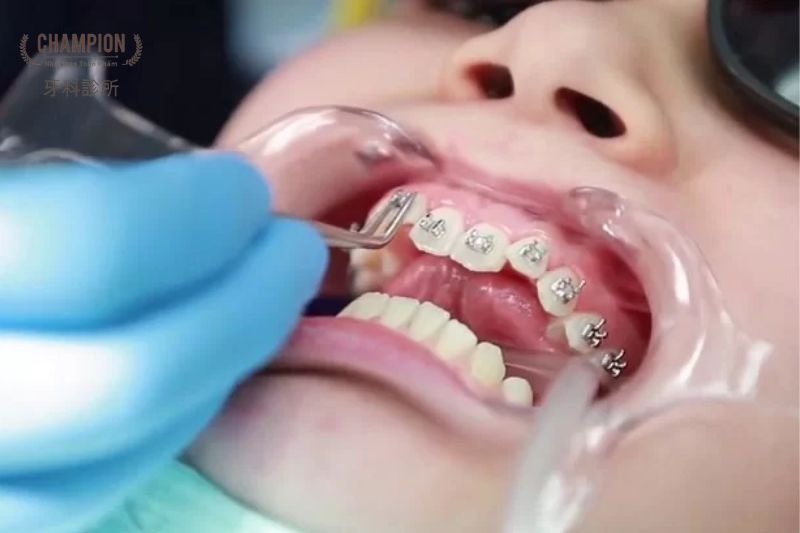 Một số lưu ý trong quá trình niềng răng mà bạn cần biết 
