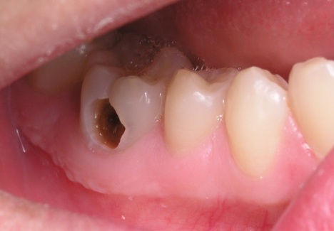 Một số triệu chứng khi xuất hiện sâu răng