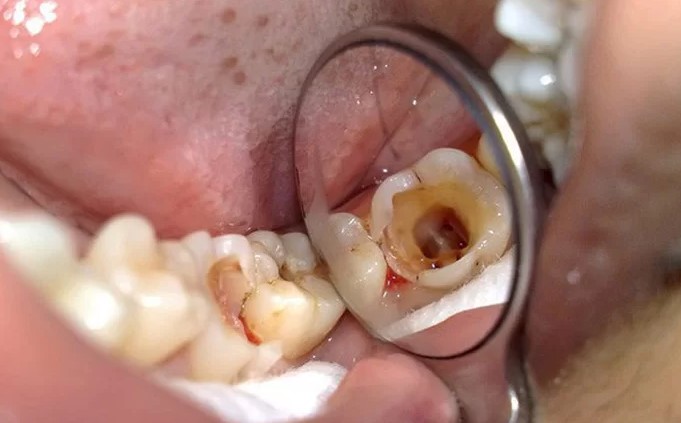 Mức độ nguy hiểm của sâu răng hàm