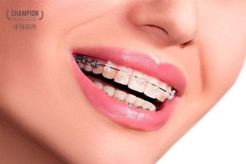 The elegance of temporary braces