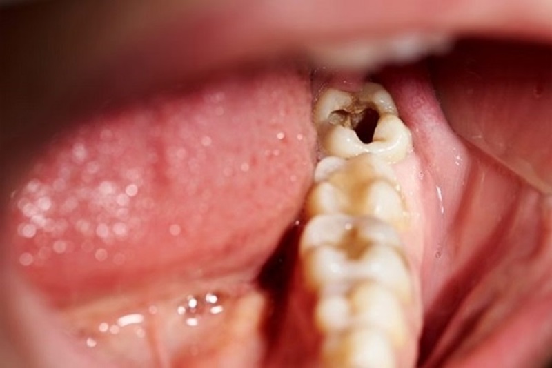 Nguyên nhân của sâu răng hàm