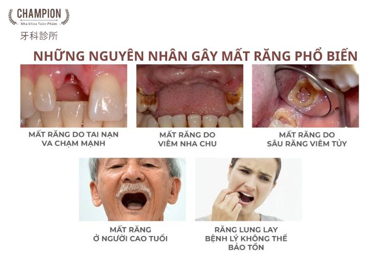 Có nên trồng lại răng sau khi mất không?