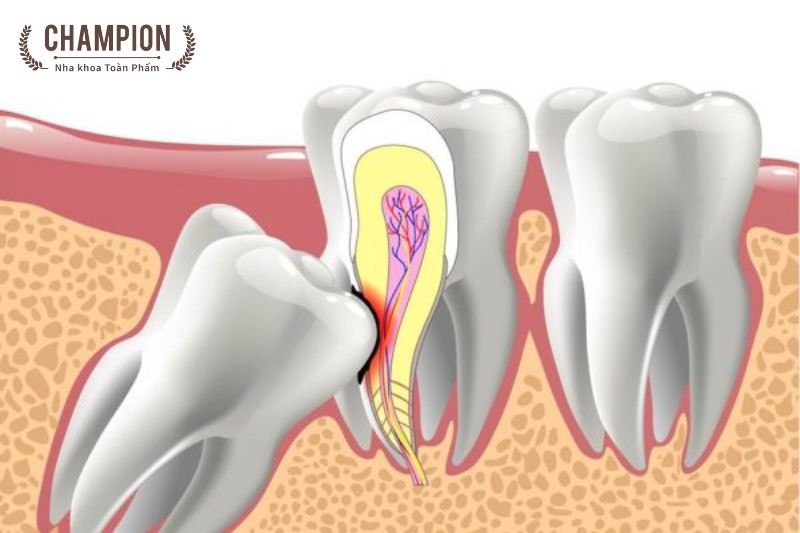 Quy trình nhổ răng số 8 diễn ra như thế nào?