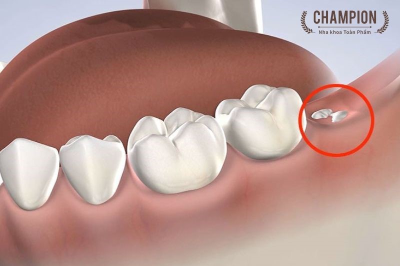 Dịch vụ nhổ răng số 8 an toàn không đau tại nha khoa Champion