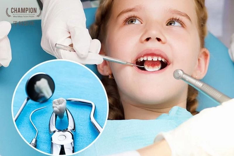 Khi nào trẻ cần đến nha khoa để nhổ răng sữa