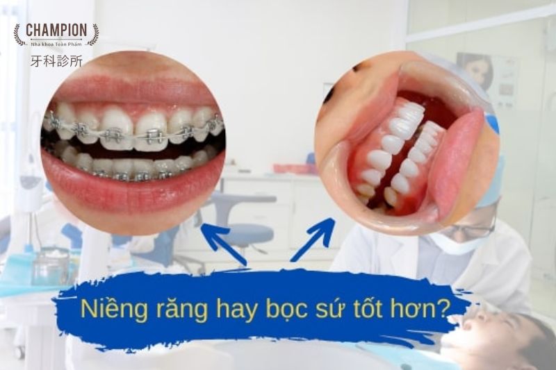 Nên niềng răng hay bọc sứ với tình trạng răng thưa, hô, lệch lạc?