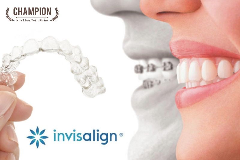 Niềng răng trong suốt Invisalign 