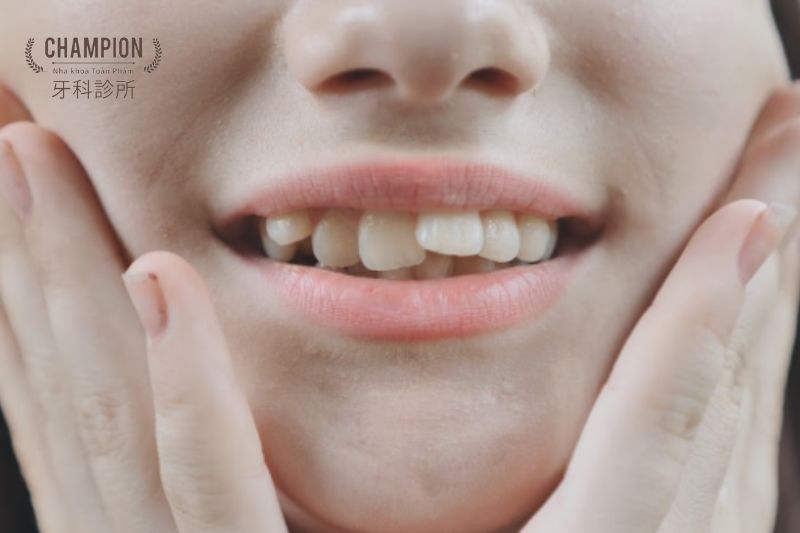 Nguyên nhân và cách phòng ngừa niềng răng xong răng bị xô lệch