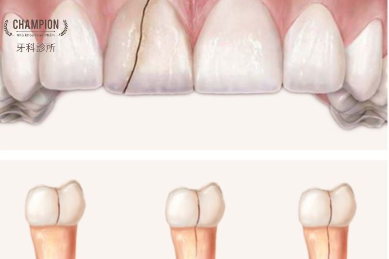 Phân biệt các loại nứt răng