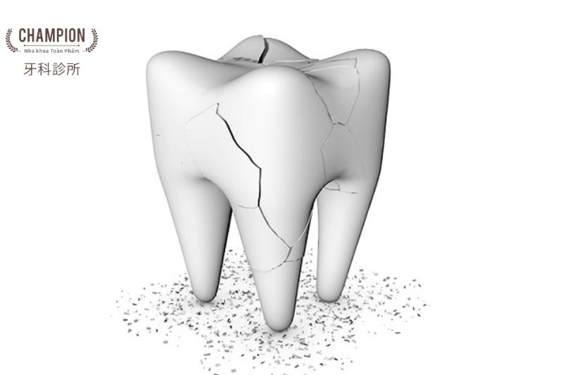 Những phương pháp chẩn đoán nứt răng hiệu quả