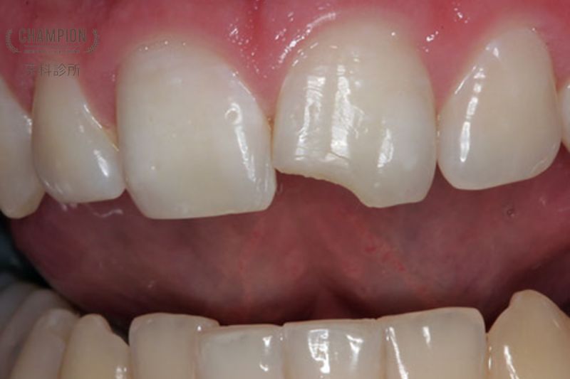 Cảnh báo: Mối liên hệ giữa nứt răng và các bệnh lý khác