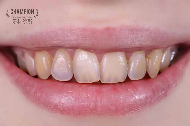Phòng ngừa mòn men răng - Bí quyết cho hàm răng khỏe mạnh