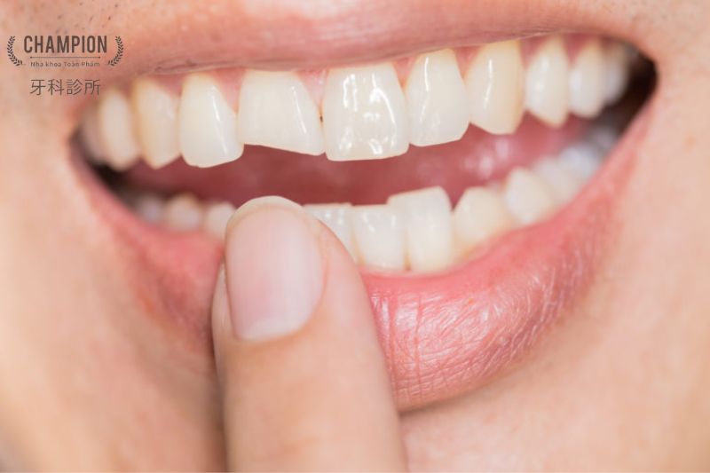 6 Cách phòng ngừa nứt răng hiệu quả mà bạn nên biết