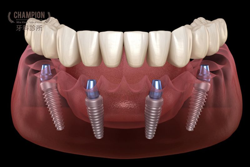 Các phương pháp phục hình răng hiện đại