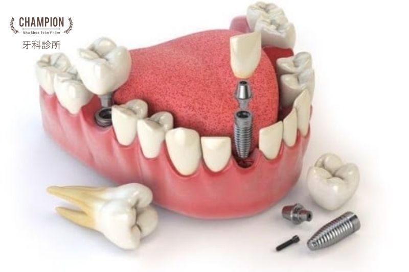Advantages and Disadvantages of Dental Implants