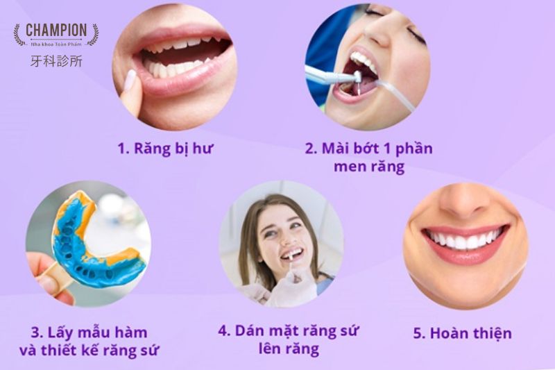 Quy trình dán sứ Veneer đạt chuẩn tại Nha khoa Champion