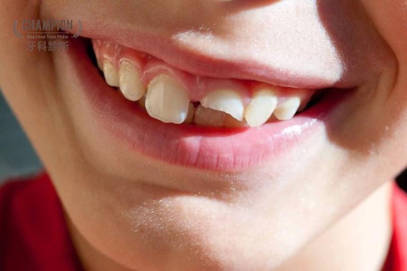 Cách nhận biết răng bị mẻ và hướng dẫn phục hồi hiệu quả, an toàn