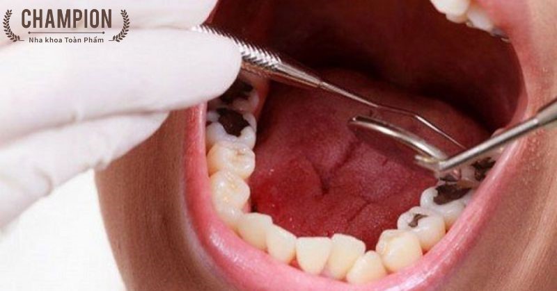 Chữa tủy răng cối - Nguyên nhân và cách điều trị hiệu quả