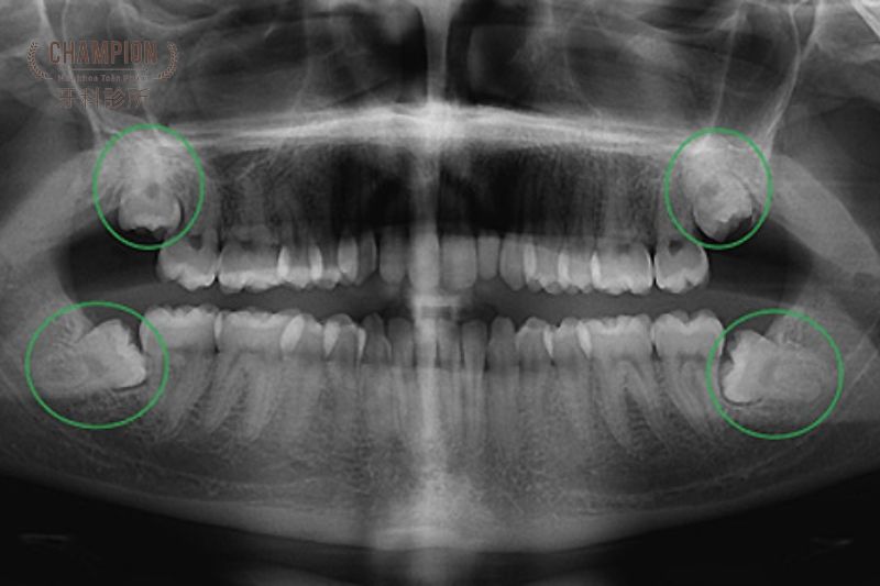 Dấu hiệu nhận biết răng khôn mọc lệch
