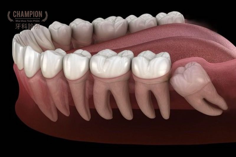 Các biến chứng nguy hiểm khi răng khôn mọc lệch