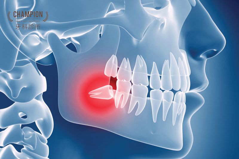 Răng khôn mọc lệch ra má có nguy hiểm không?