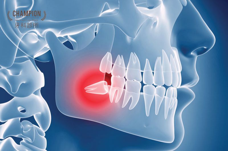 Nguy cơ và giải pháp điều trị khi răng khôn mọc lệch ra má