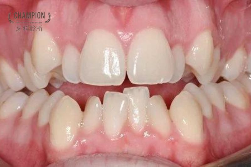Răng quá khít: Nguyên nhân, hậu quả và cách điều trị hiệu quả