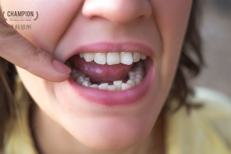 Răng quá khít ở người lớn: Điều trị thế nào an toàn?