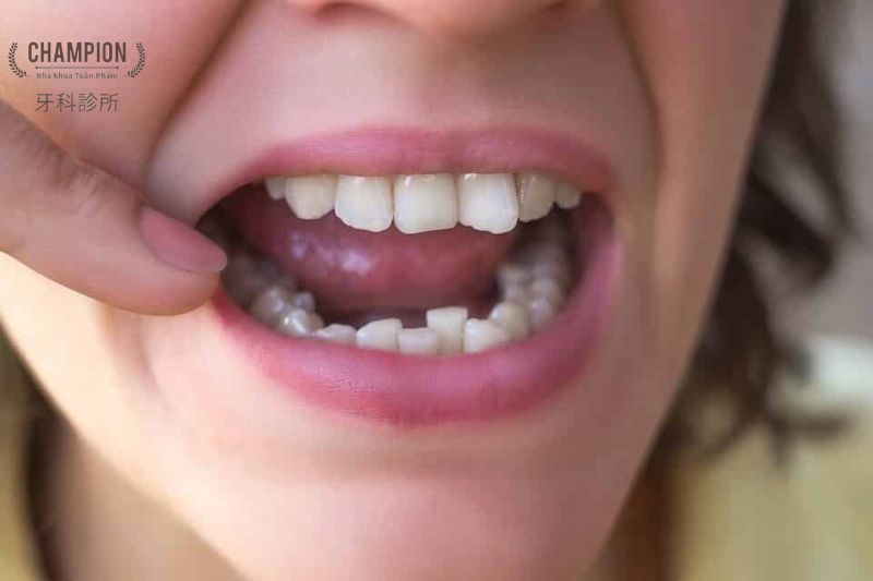 Phân biệt răng quá khít và răng thưa: Chọn phương pháp điều trị phù hợp