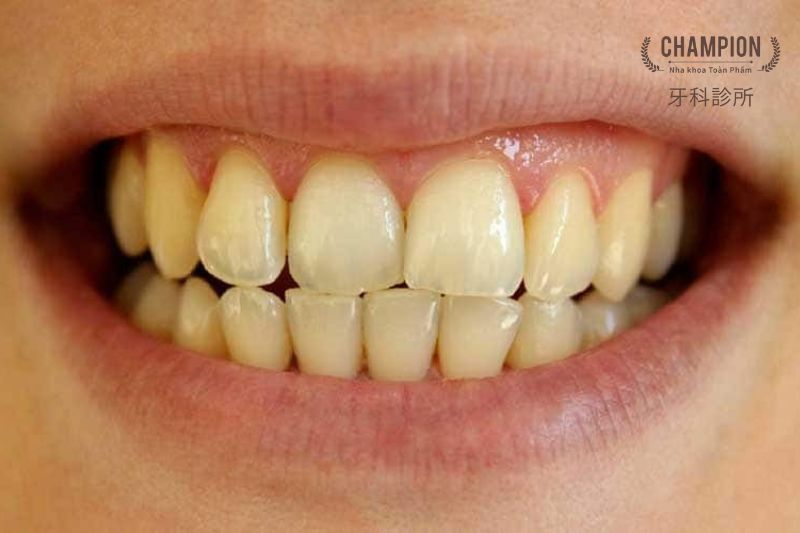 Răng xỉn màu ảnh hưởng sức khoẻ như thế nào? Biện pháp khắc phục