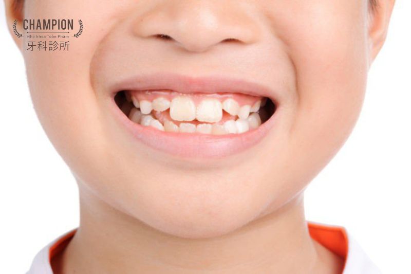 Bạn có biết răng xô lệch ảnh hưởng đến sức khỏe và thẩm mỹ thế nào?