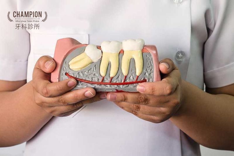 Mọc răng khôn khiến răng xô lệch - Cần được nhổ răng khôn khi nào?