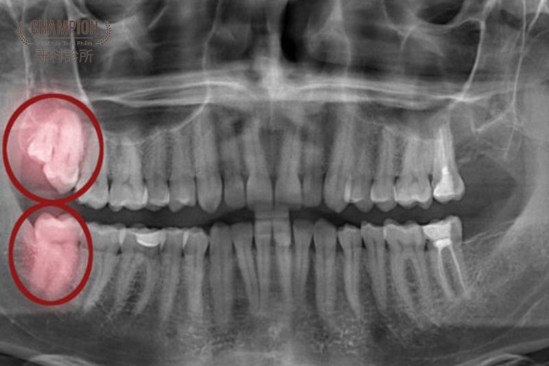 Tác hại của răng xô lệch do mọc răng khôn