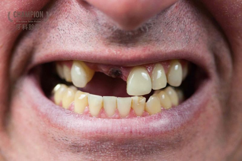 5 sai lầm thường gặp khi mất răng và cách khắc phục