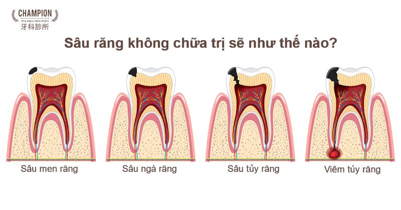 Sâu răng và những tác hại từ việc không được chữa trị